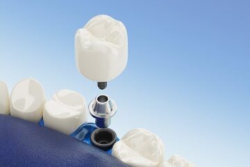 Close up component of dental implants transparent. 3d rendering.
